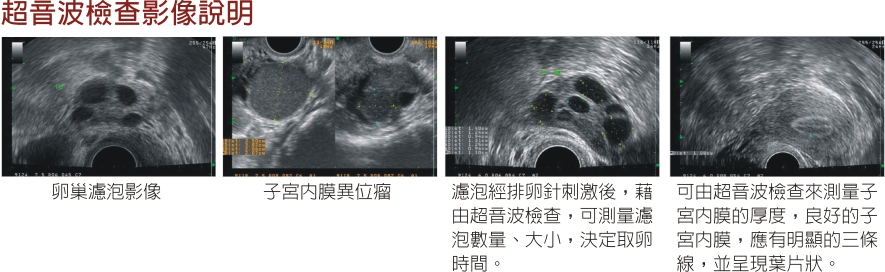 子宫卵巢超音波检查及滤泡测量(Folliculometry)